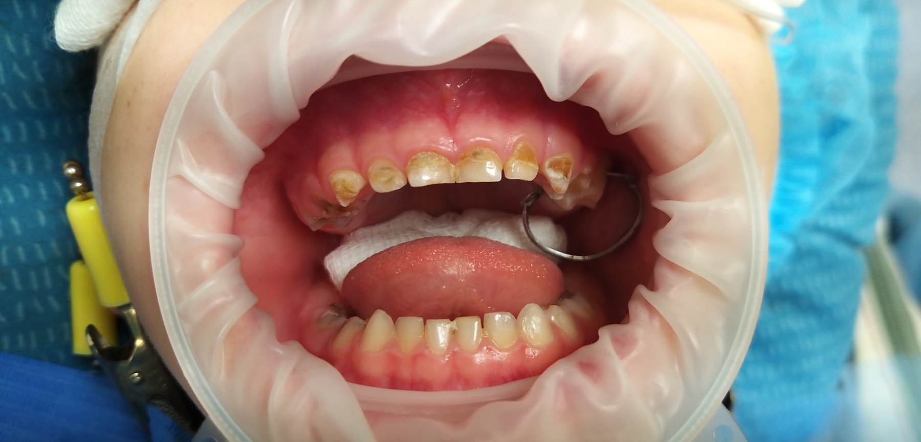 лікування дитячих зубів під седацією 2