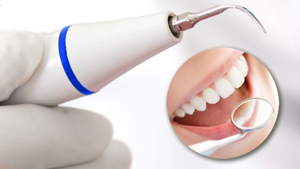 Комплексна чистка зубів- 30% знижка щонеділі