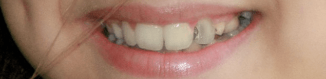 Комплексна чистка зубів і фторування  2