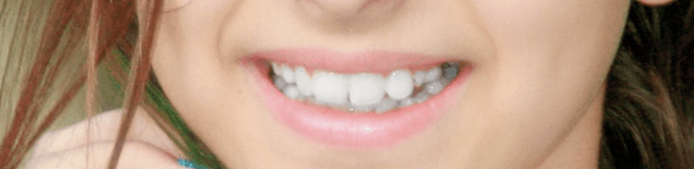 Комплексна чистка зубів і фторування  3
