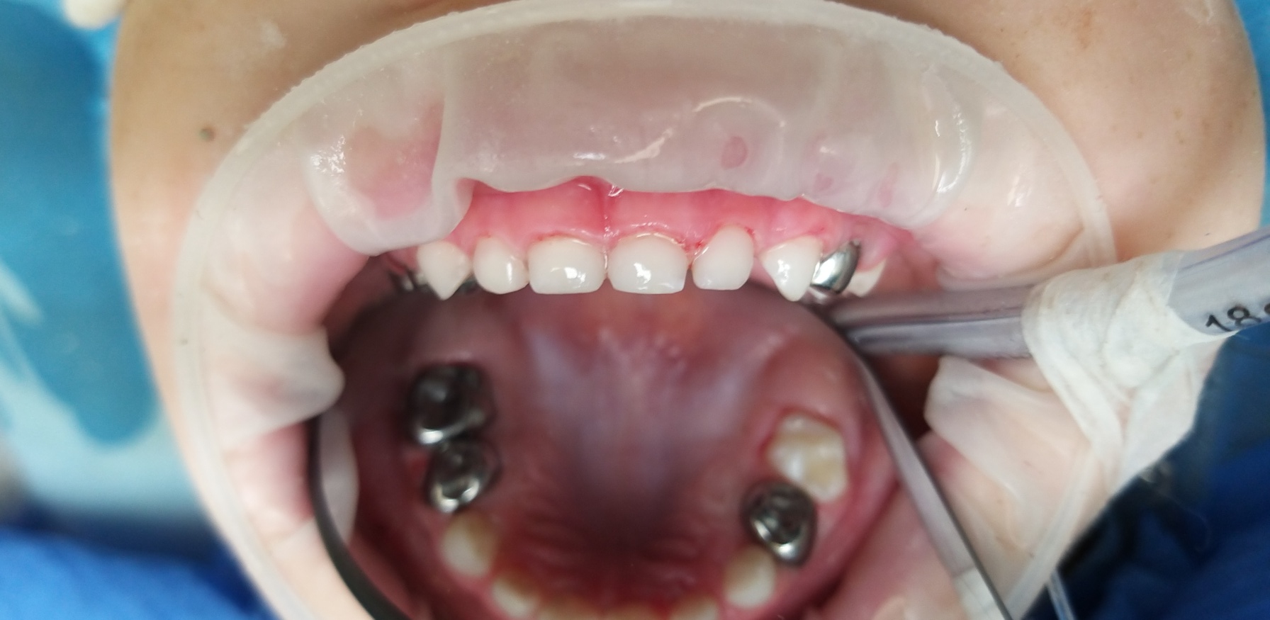 лікування дитячих зубів під седацією